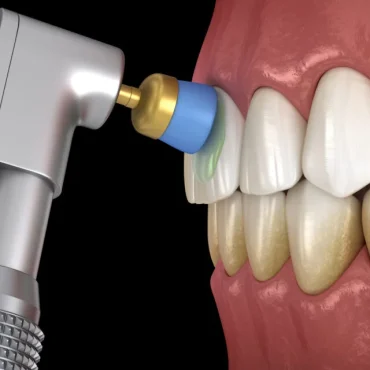 3d-illustration-of-dental-prophylaxis-procedure-Teeth-polishing-procedure-with-professional-brush-and-gel-1024x640