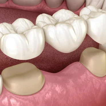 Cosmetic-Dentistry-Procedures-3-How-Do-Dental-Bridges-Work.jpg
