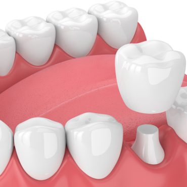 IMG-dental-crown-GettyImages-940971686