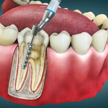 Root-Canal-1024x683