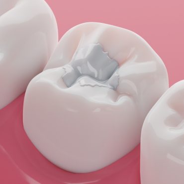 composite-filling-procedure