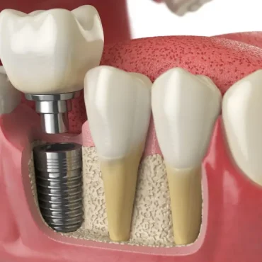 dental-implants-1-920x690.jpg