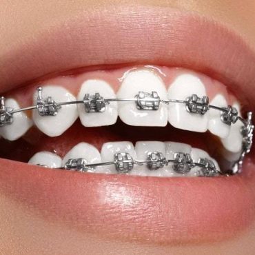 metalCeramicBracesProduct