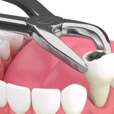 tooth-extraction-dental-service.jpg tooth-extraction-dental-service.jpg