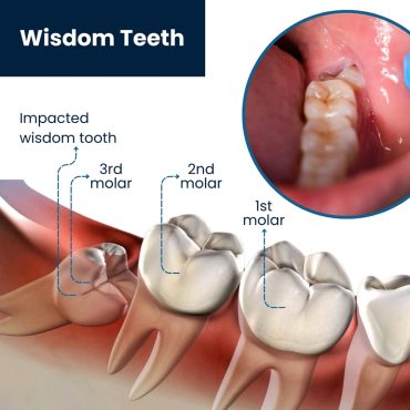 wisdom-tooth wisdom-tooth